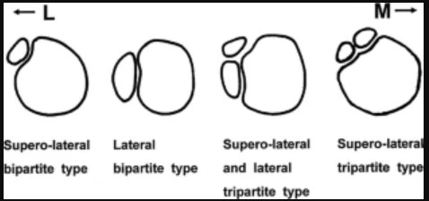 大橋分類（Oohashi Classification）― 分裂膝蓋骨の分類図。Supero-lateral bipartite type・Lateral bipartite type・Supero-lateral and lateral tripartite type・Supero-lateral tripartite typeの4型